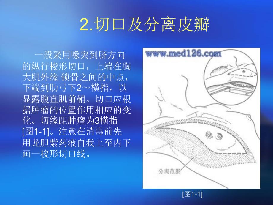 乳腺癌根治术步骤课件.ppt_第3页