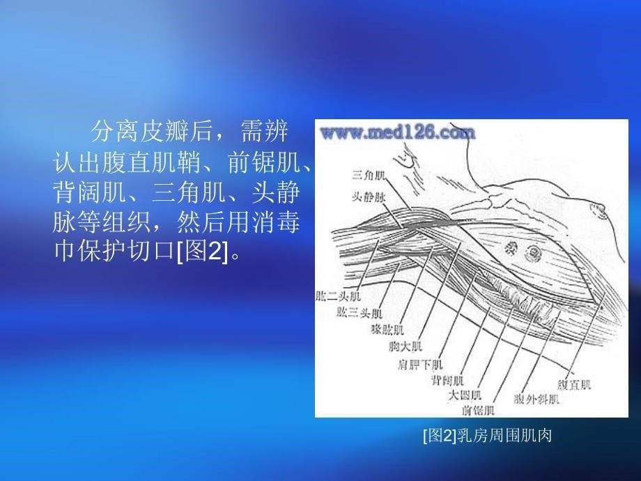 乳腺癌根治术步骤课件.ppt_第5页