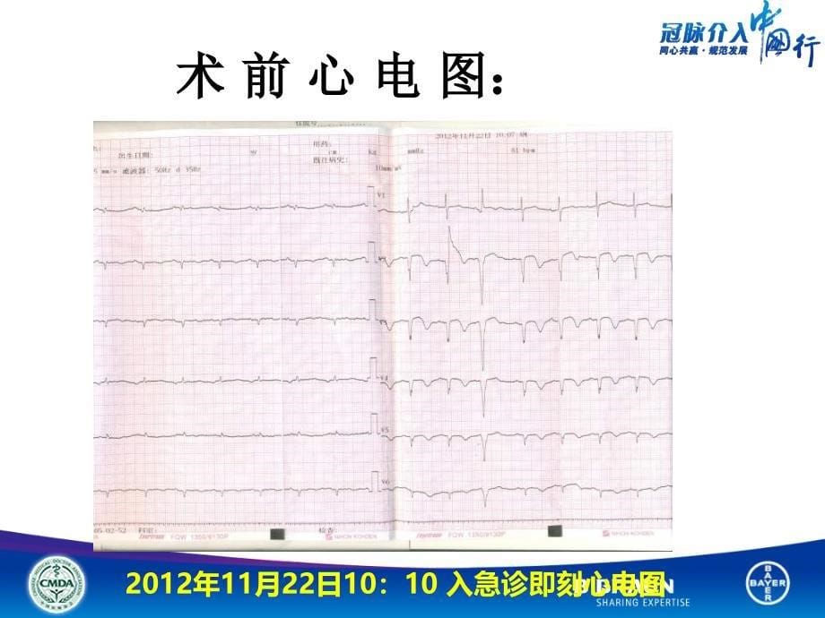 课件三只病变的急非ST段抬高心梗行急诊PCI治疗策略如何抉择_第5页