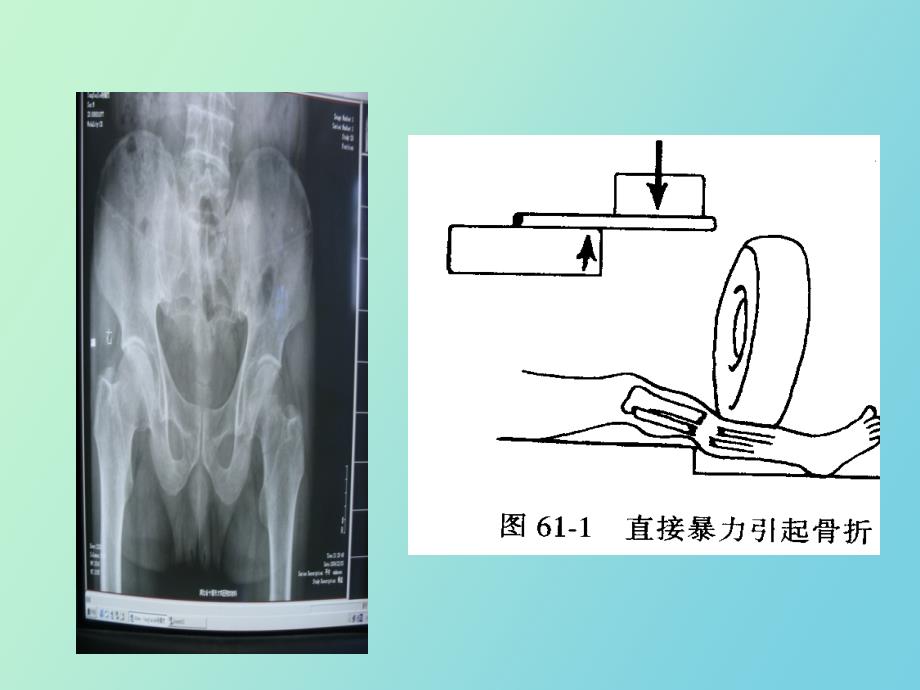 骨折病人的护理_第3页