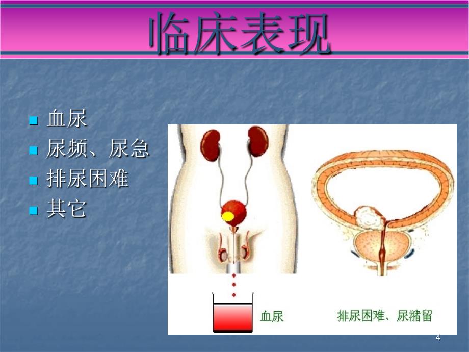 膀胱肿瘤患者术后膀胱灌注的护理ppt课件_第4页