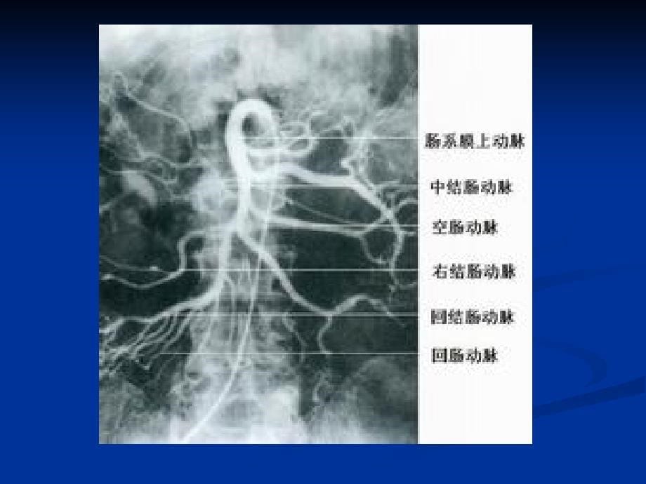 急性肠系膜上动脉栓塞培训ppt课件_第5页