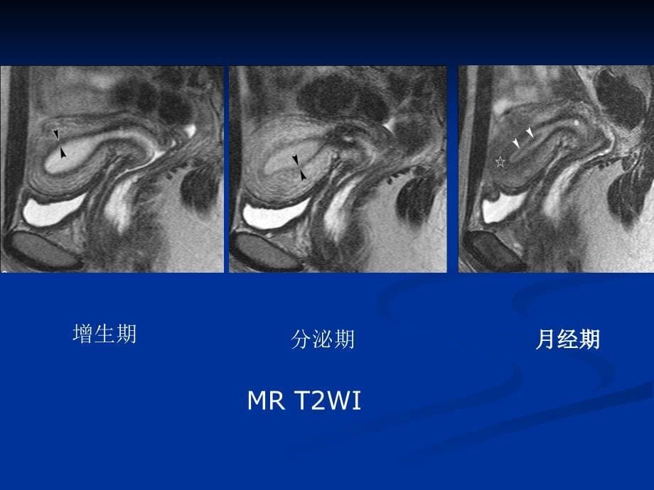 子宫恶性肿瘤的MR诊断_第5页