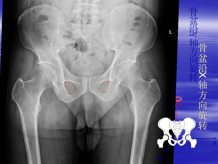髋关节X线片测量角度_第4页