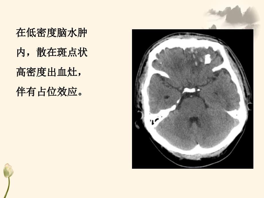 医学影像诊断中常见疾病的CT、MRI诊断_第4页