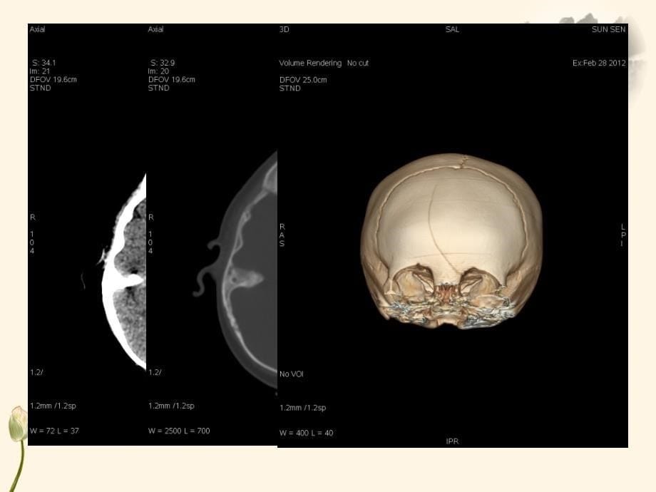 医学影像诊断中常见疾病的CT、MRI诊断_第5页