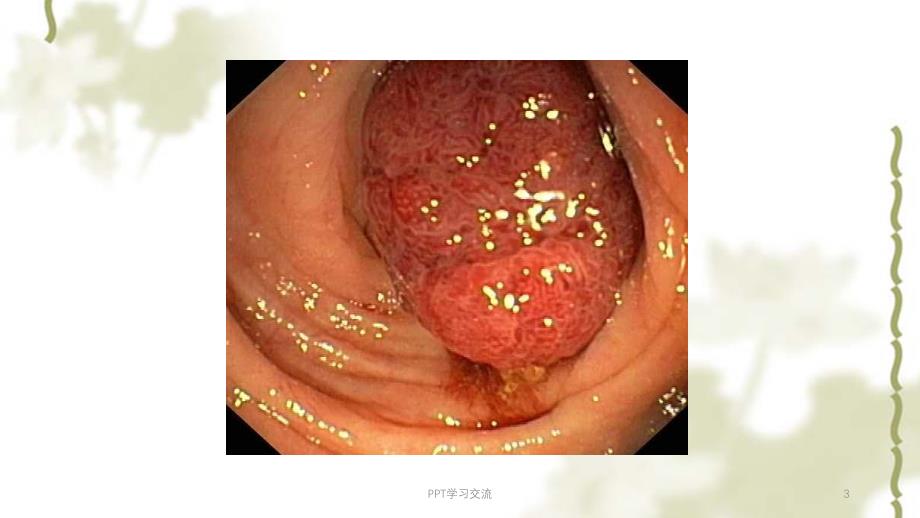 肠息肉的诊治课件_第3页