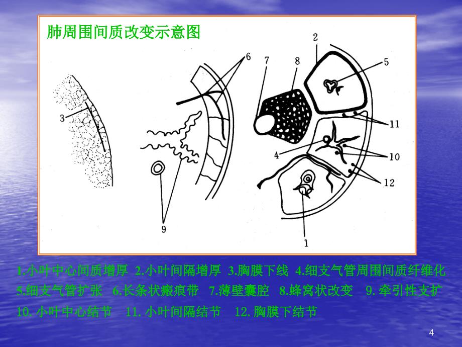 肺间质疾病ppt课件_第4页