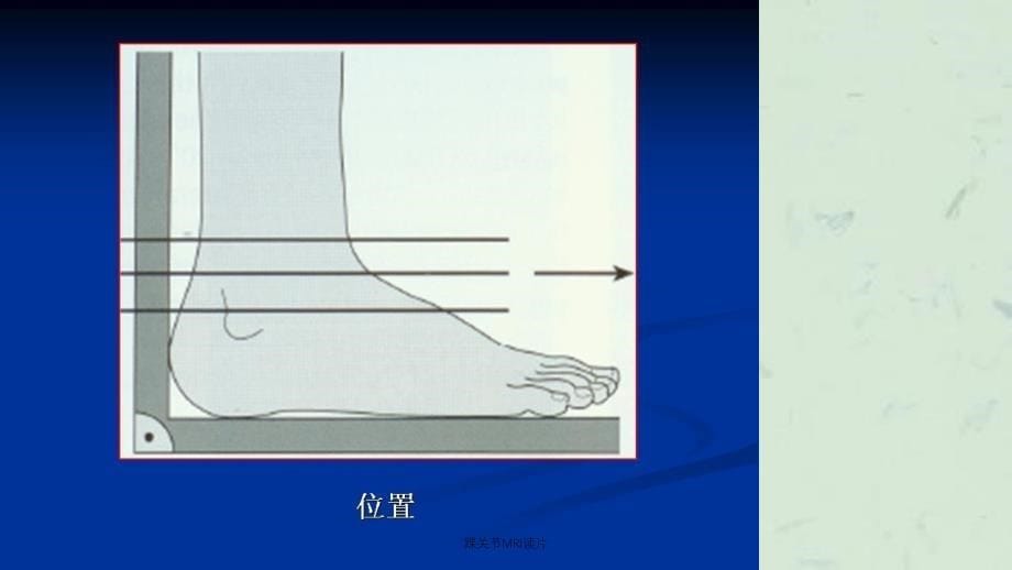 踝关节MRI读片课件_第5页