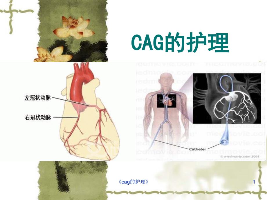 cag的护理课件_第1页