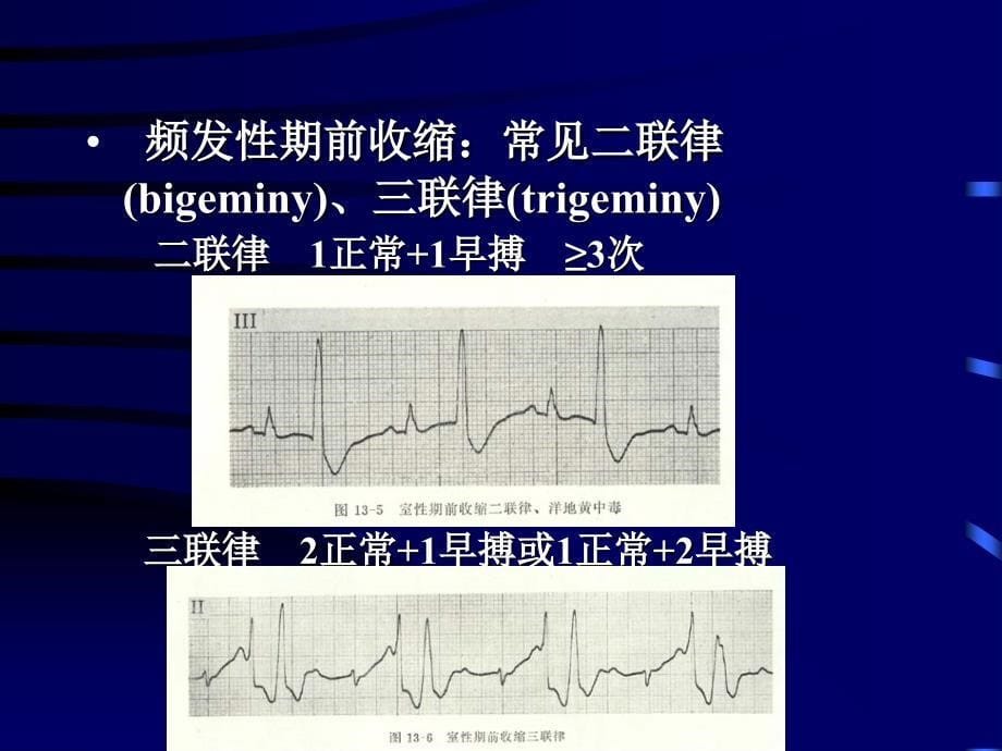 [精品]二过早搏动(premature_第5页