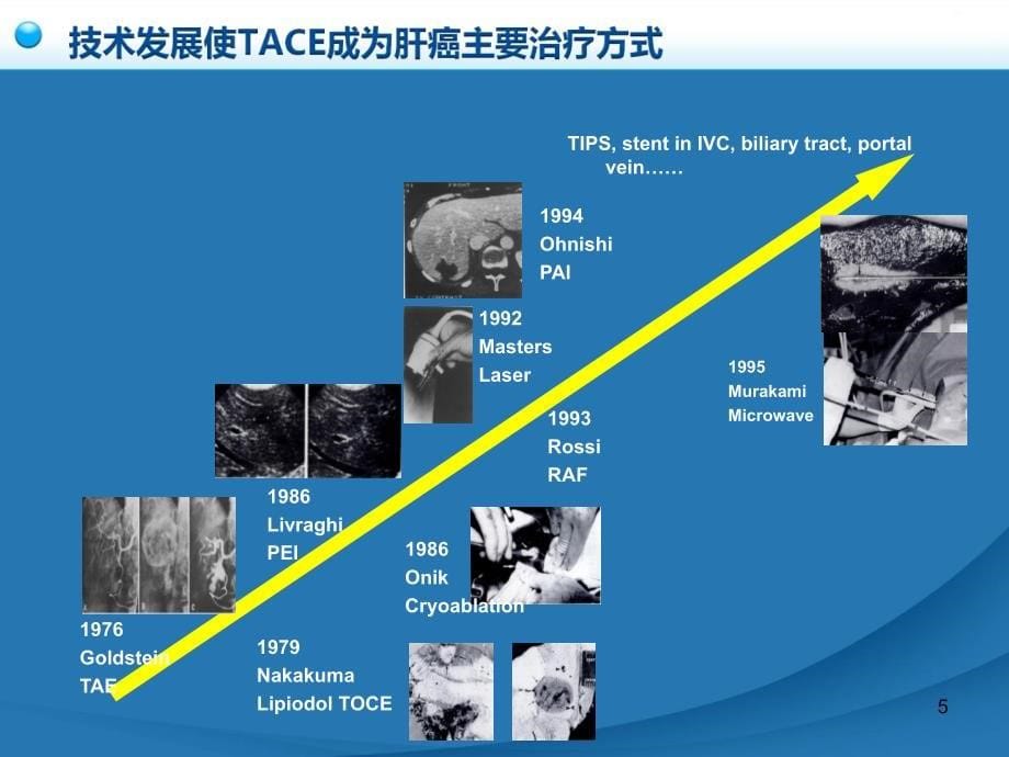 卫生部原发性肝癌诊疗规范之介入治疗ppt课件_第5页