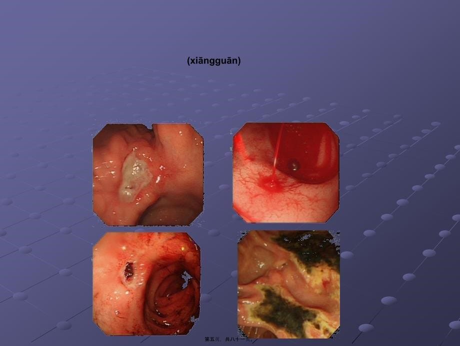 上消化道出血的诊治基础和进展课件_第5页