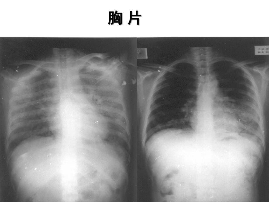 协和医院机械通气临床应用_第5页