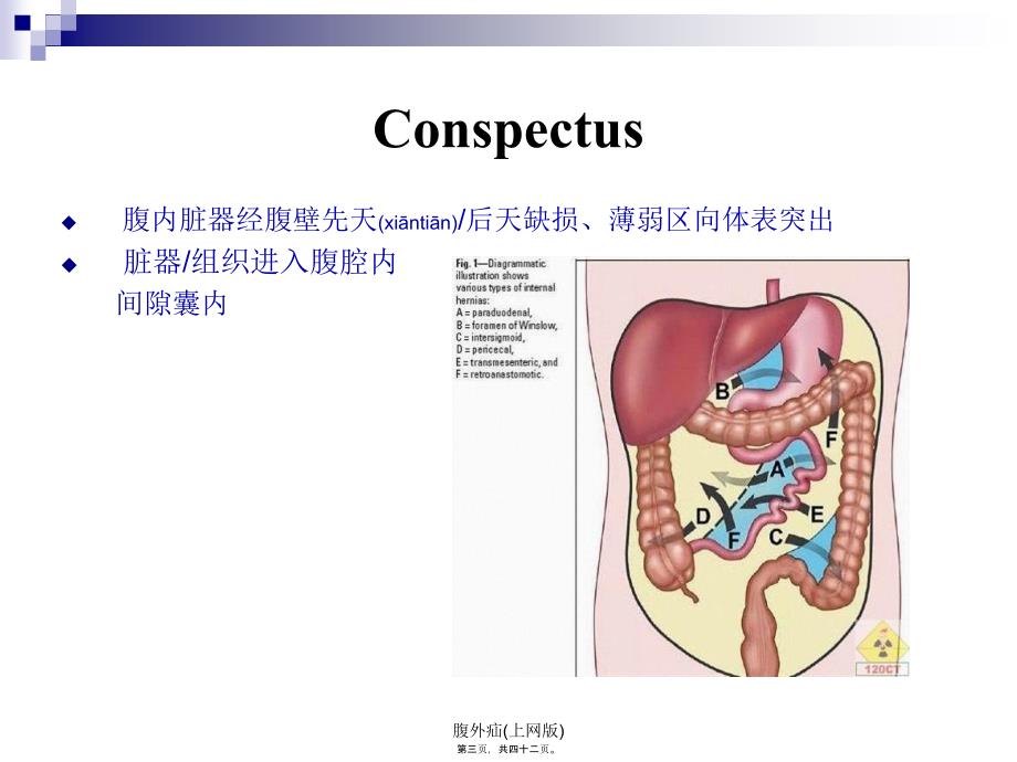 腹外疝上网版课件_第3页