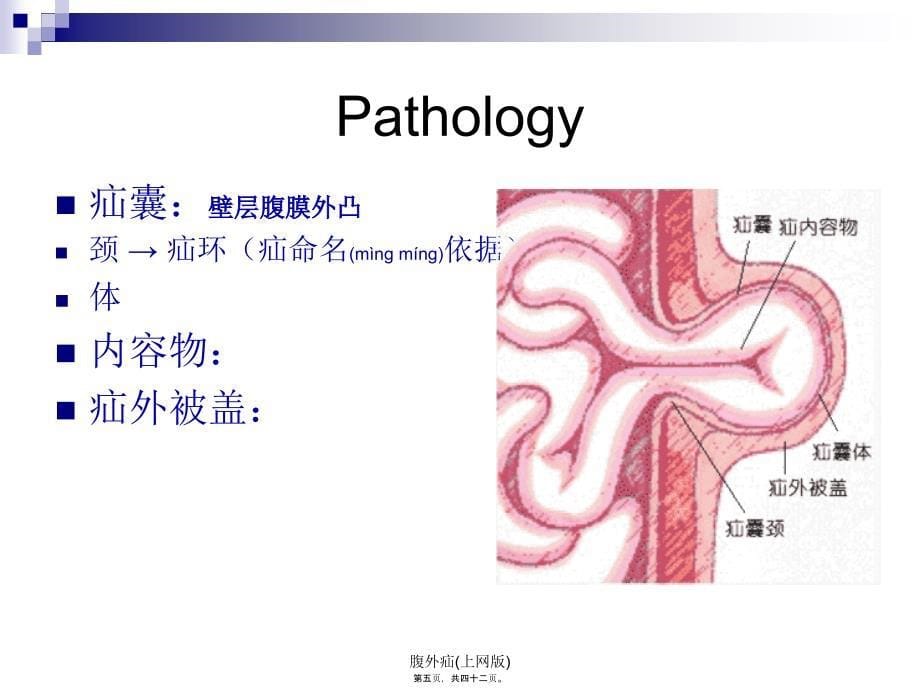 腹外疝上网版课件_第5页