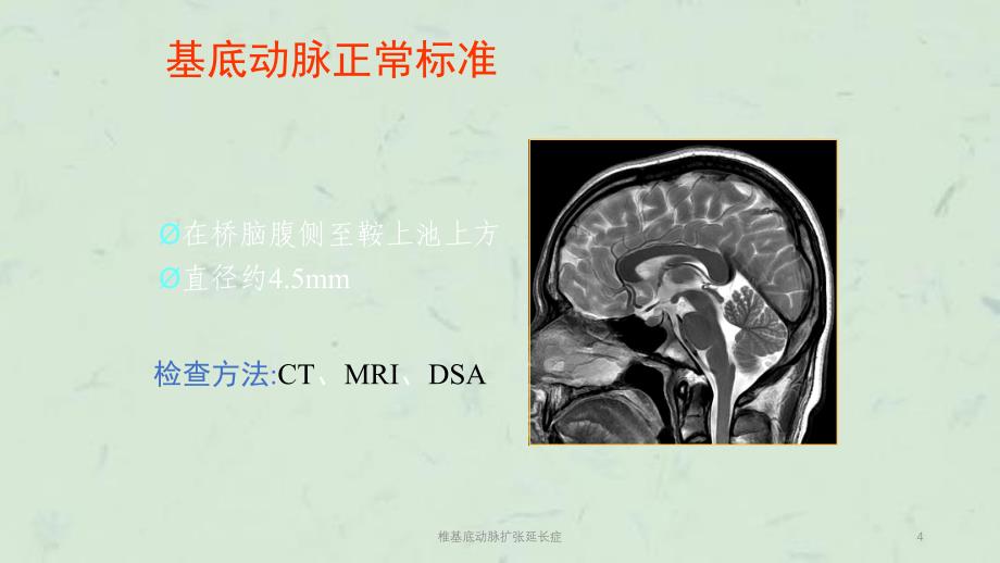 椎基底动脉扩张延长症课件_第4页