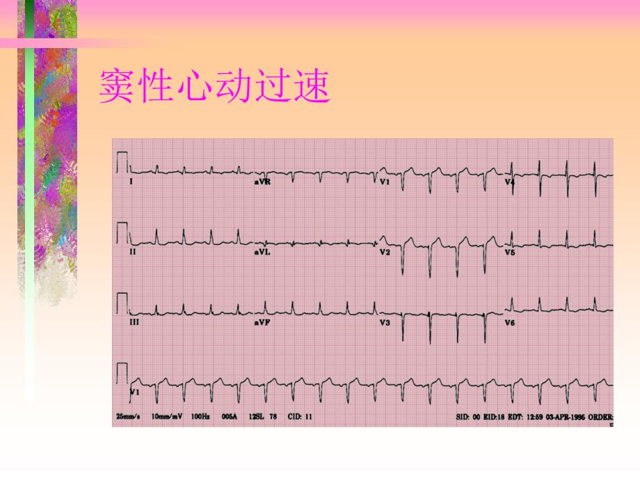 第二十二章围术期心律失常_第4页