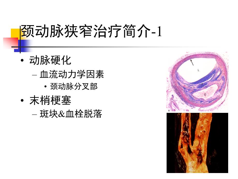 颈动脉与颅内支架课件_第2页