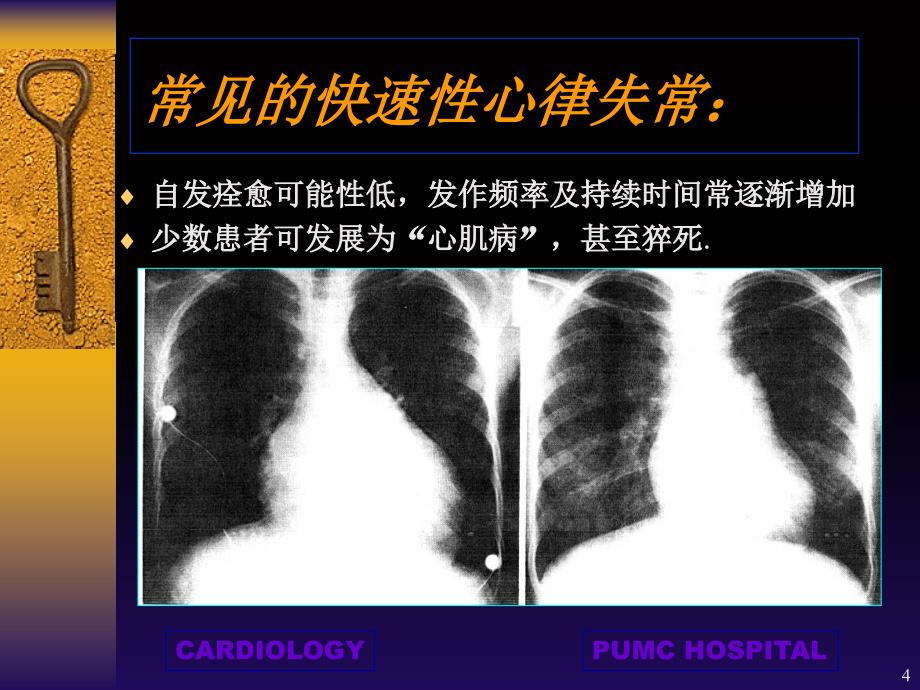 快速性心律失常优秀课件_第4页