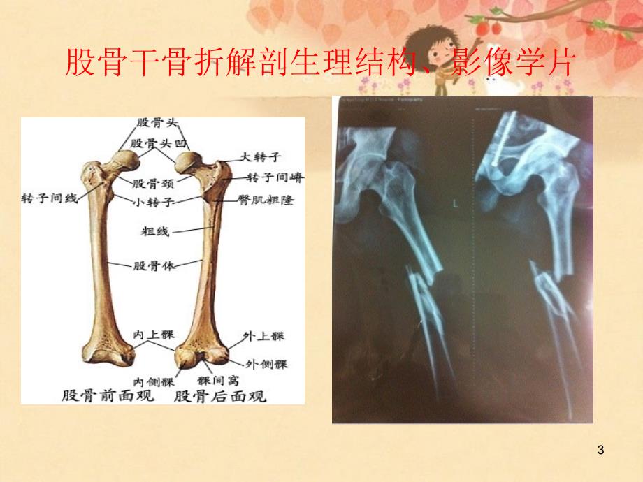 推荐精选股骨骨折护理查房_第3页