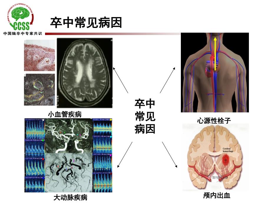 卒中危险因素分层及预防策略课件_第4页