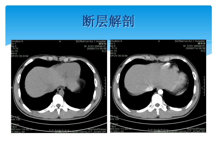 上腹部实质性脏器影像诊断_第2页