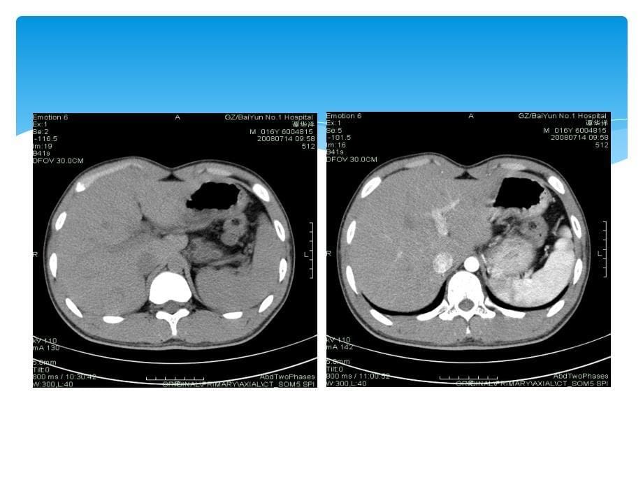 上腹部实质性脏器影像诊断_第5页