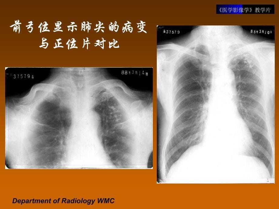 《医学影像学》实验课件（临床专业）：2008呼吸系统-1_第5页