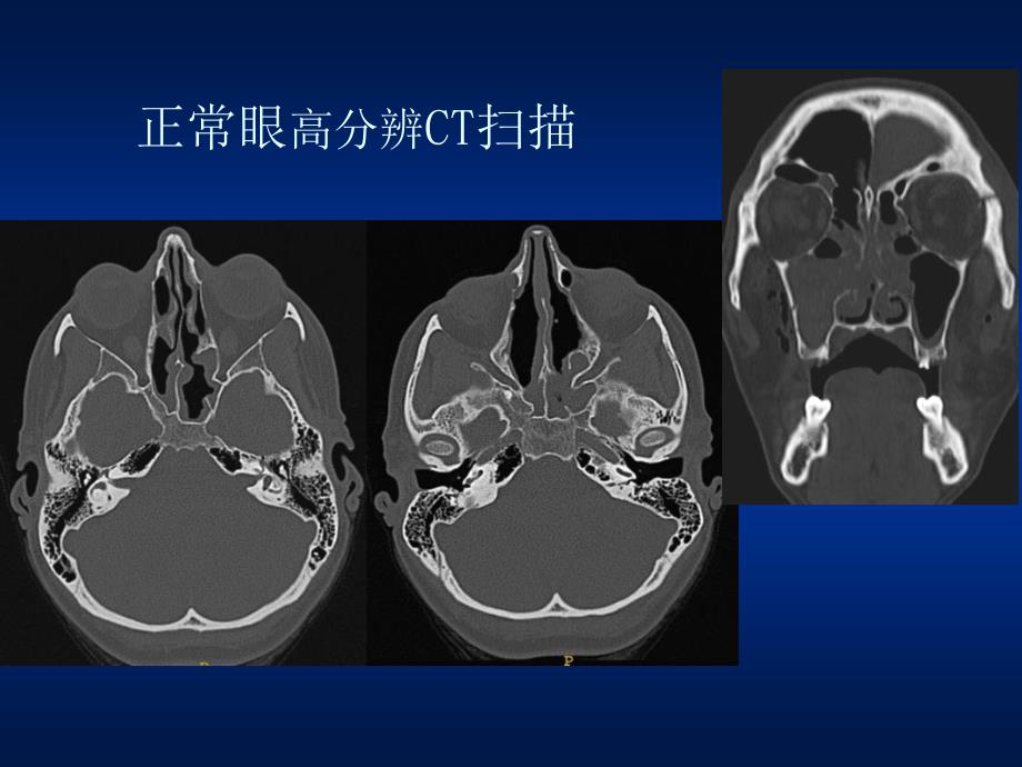 甲状腺相关眼部病变的MR影像诊断_第4页