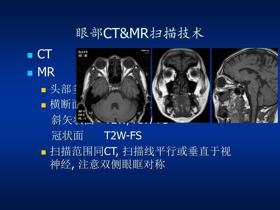 甲状腺相关眼部病变的MR影像诊断_第5页