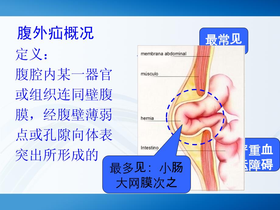 腹股沟疝护理_第3页