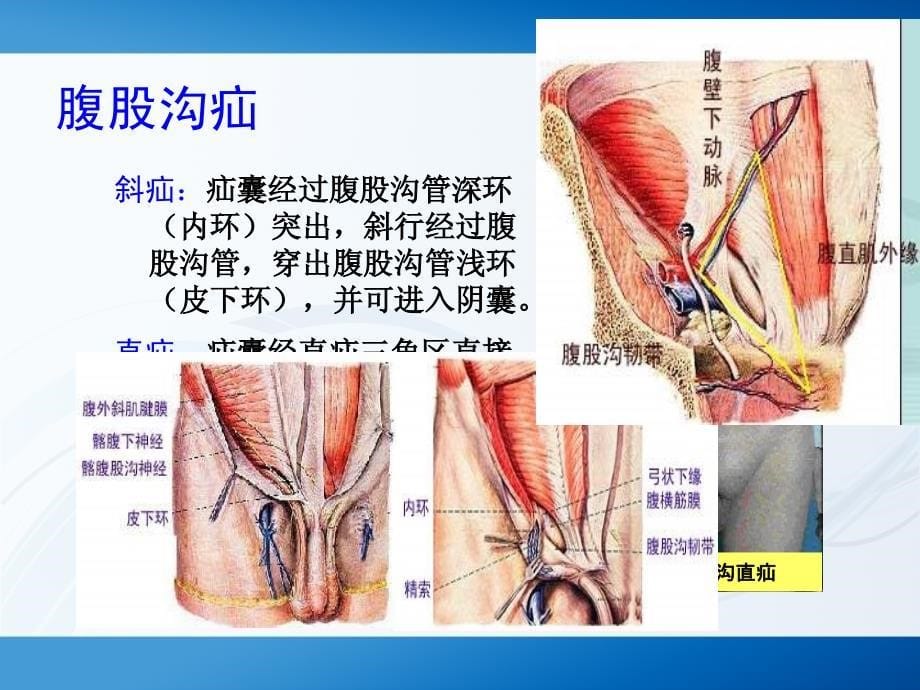 腹股沟疝护理_第5页