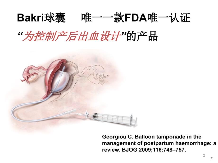 BAKRI子宫填塞球囊导管PPT参考幻灯片_第2页