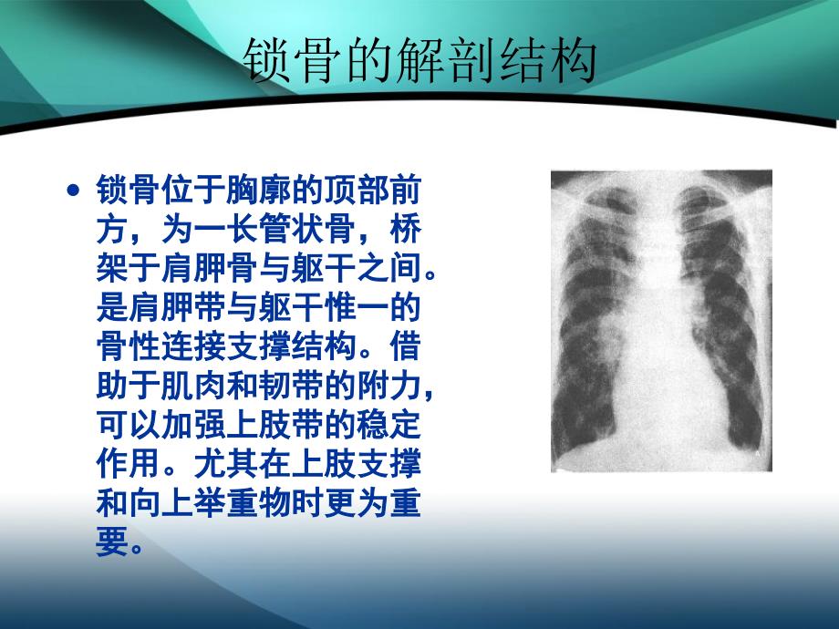 锁骨骨折的护理课件_第2页