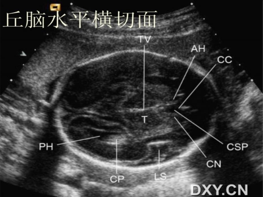 胎儿超声标准切面_第3页