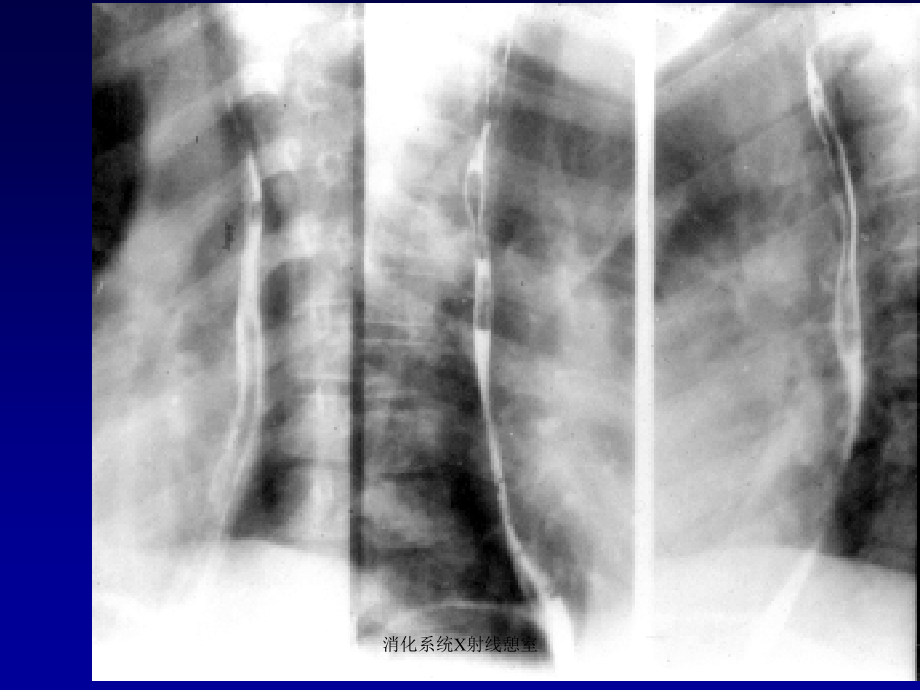 消化系统X射线憩室课件_第3页