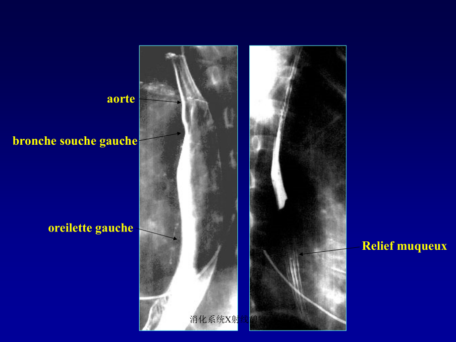 消化系统X射线憩室课件_第4页