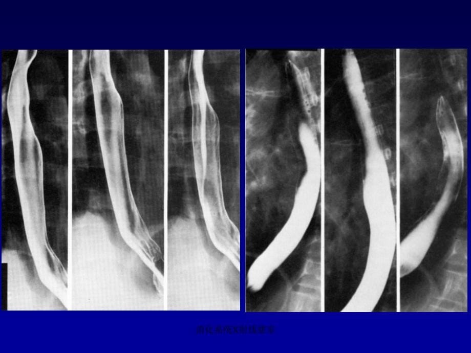 消化系统X射线憩室课件_第5页