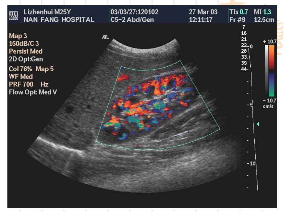 泌尿系统超声诊断_第4页