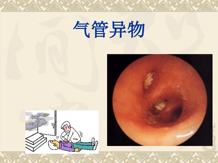 气管支气管及食管异物(2)教学提纲_第2页