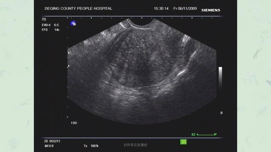 妇科常见急腹症课件_第3页