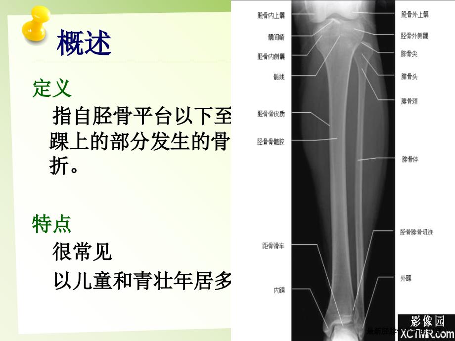 最新胫腓骨骨折的护理_第4页