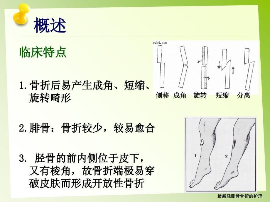 最新胫腓骨骨折的护理_第5页