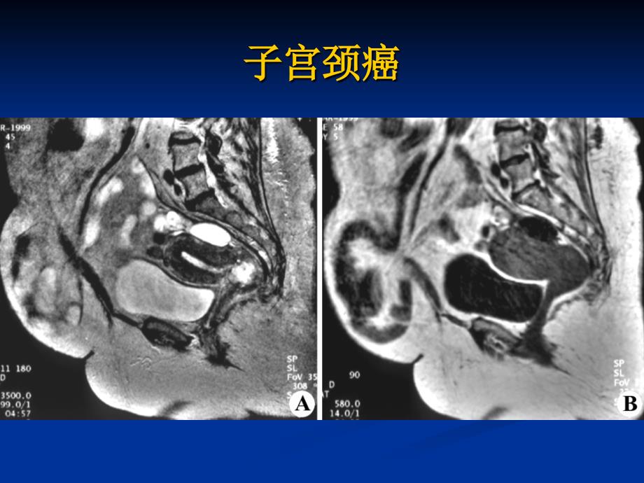 最新MRI在妇产科疾诊断的应用课件精选PPT文档_第4页