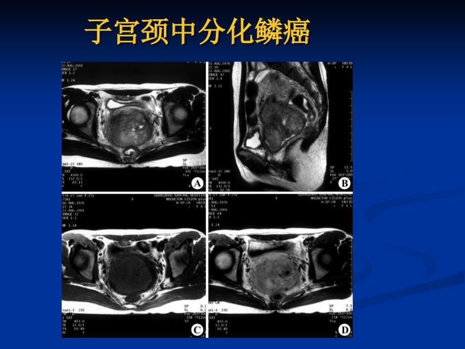 最新MRI在妇产科疾诊断的应用课件精选PPT文档_第5页