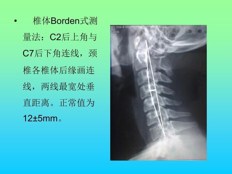 常用脊柱测量方法及其临床意义_第5页