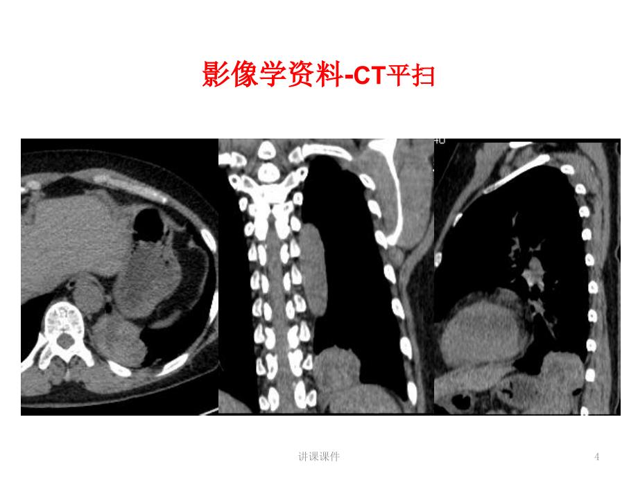 肺硬化性肺泡细胞瘤【专业研究】_第4页