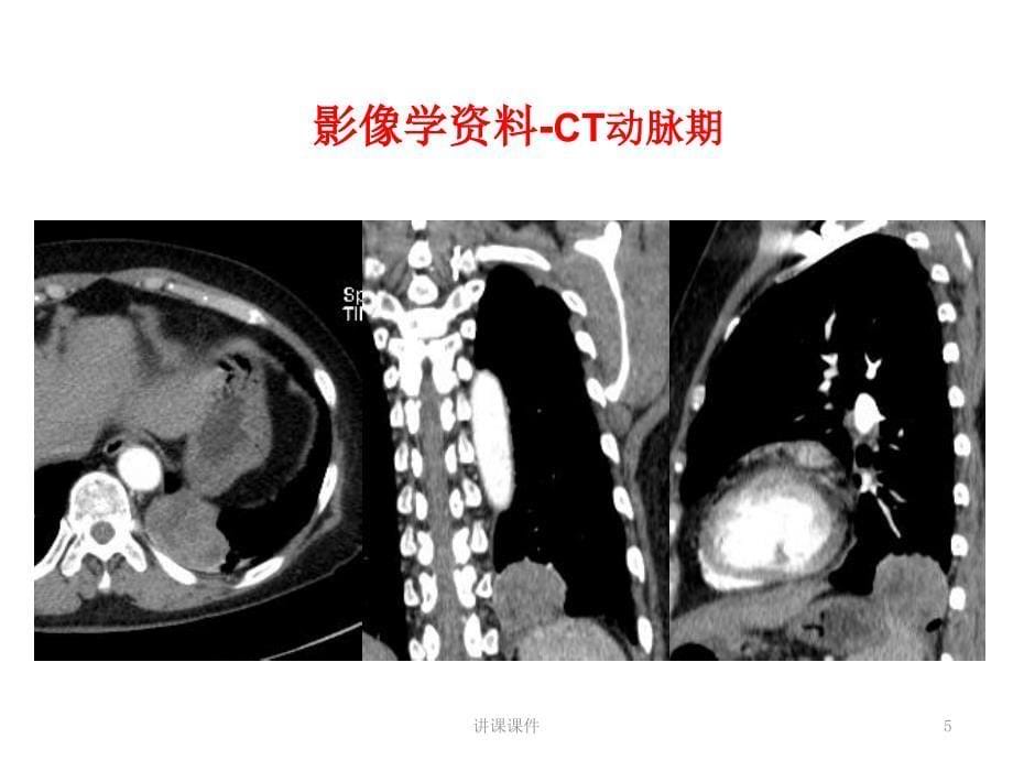 肺硬化性肺泡细胞瘤【专业研究】_第5页