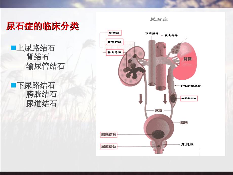 结石医患沟通课件_第3页